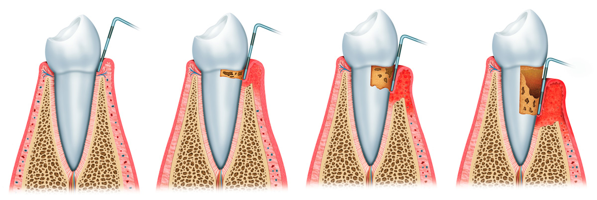 morfes-periodontidas