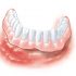 Σταθεροποίηση οδοντοστοιχίας με οδοντικά εμφυτεύματα (Επένθετες οδοντοστοιχίας)